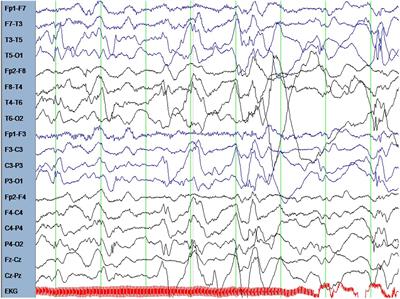 MAP2 – A Candidate Gene for Epilepsy, Developmental Delay and Behavioral Abnormalities in a Patient With Microdeletion 2q34